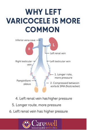 “Diagram of varicocele showing enlarged veins on left side vs right side, anatomy differences, and impact on male infertility.”