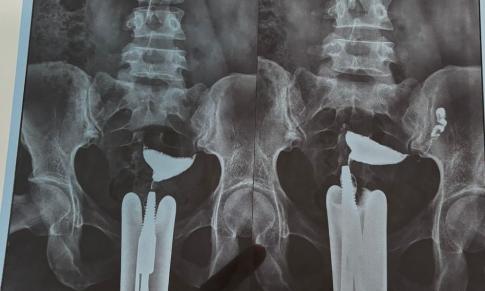 Natural pregnancy after ectopic pregnancy with right tube removal and blocked fallopian tube at Carewell Fertility Clinic Kerala