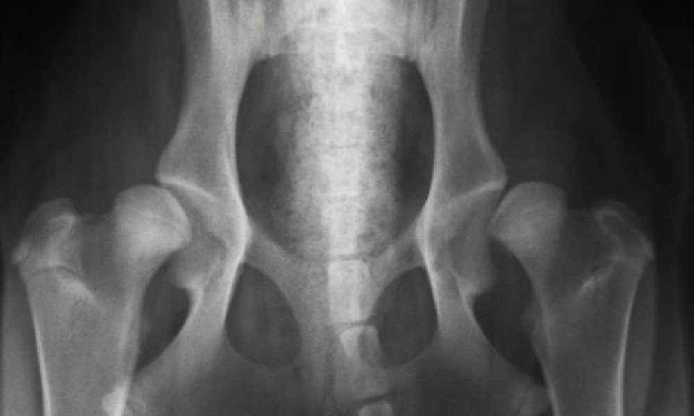 bilateral tube block